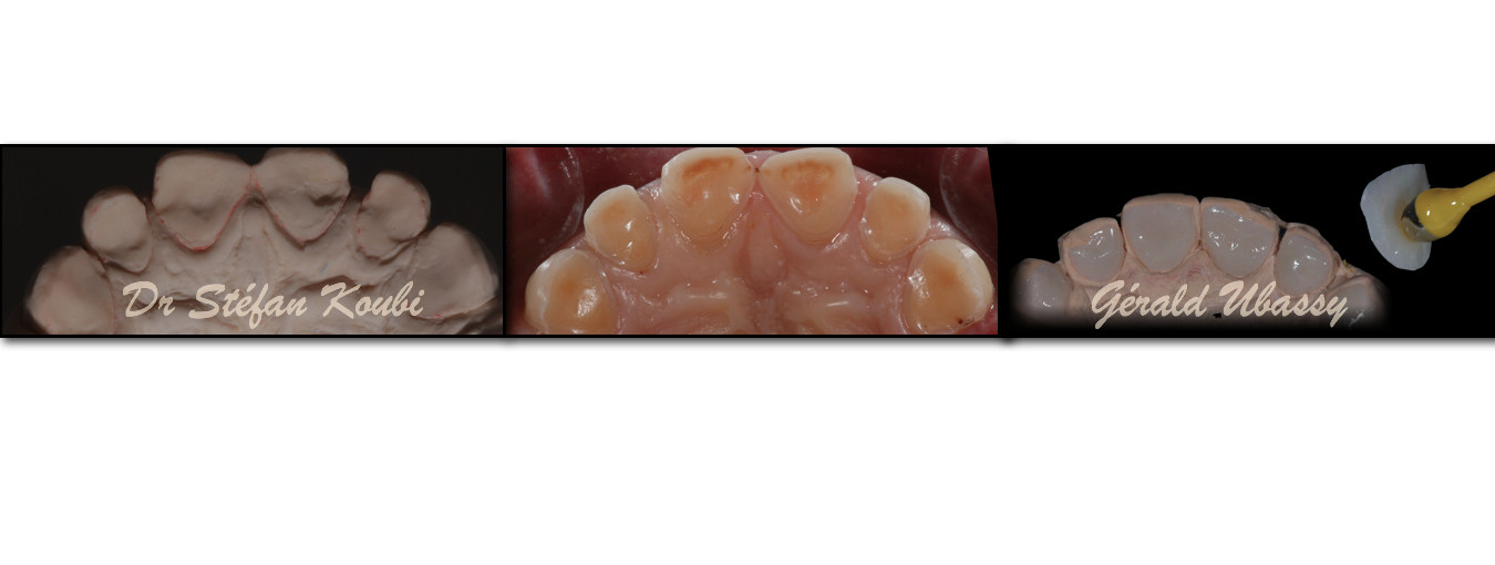 veneers and crowns /Dr Stefan Koubi